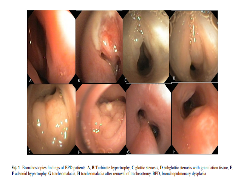 esame Broncoscopia flessibile nei neonati pretermine con displasia broncopolmonare